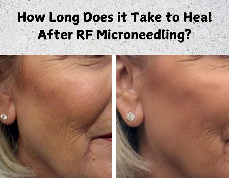 How Long Does it Take to Heal After RF Microneedling? How Long Does it Take to Heal After RF Microneedling