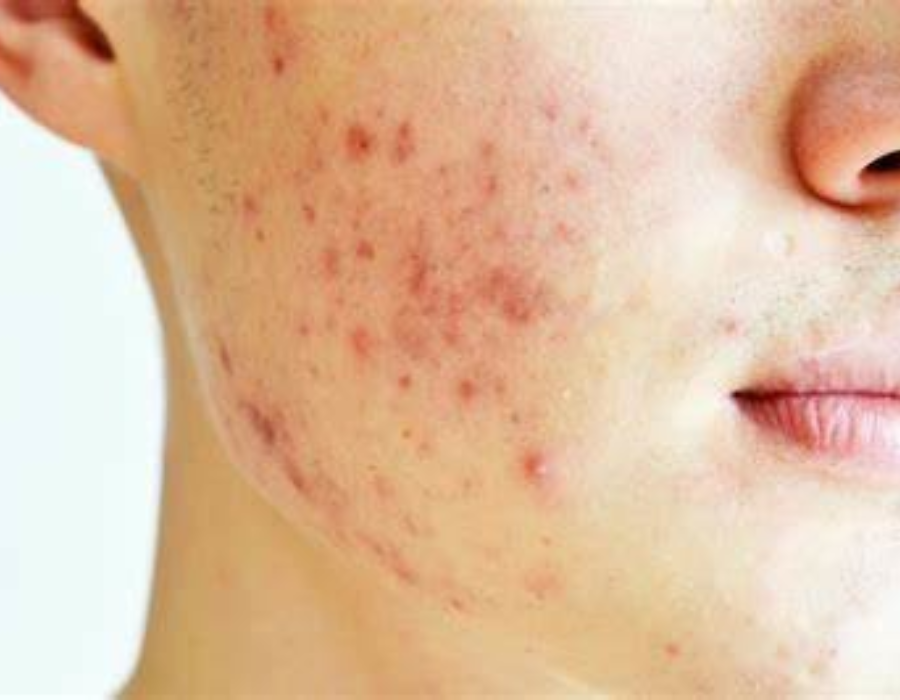 How to Prevent Acne Scars Naturally: Tips from Dr. Aiza Jamil How to Prevent Acne Scars Naturally