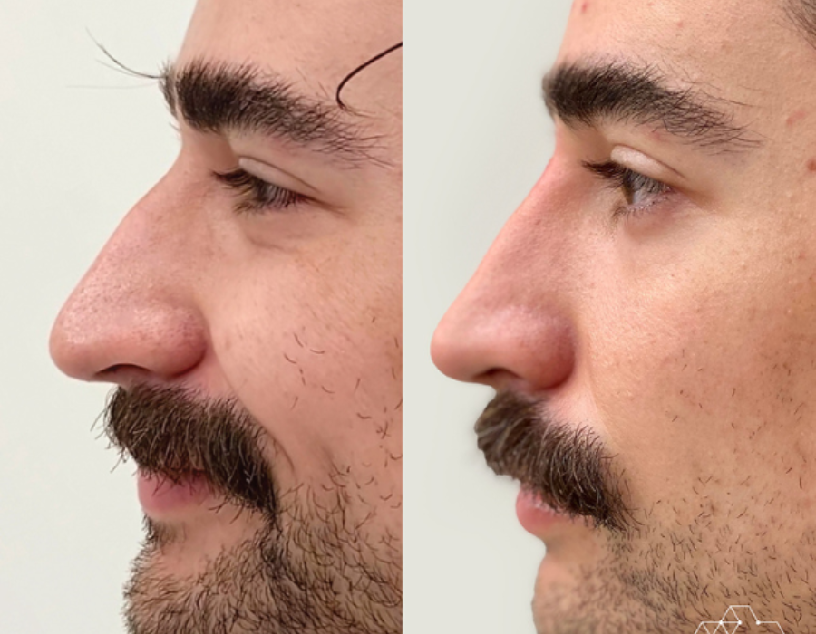 Non-Surgical Rhinoplasty Abu Dhabi