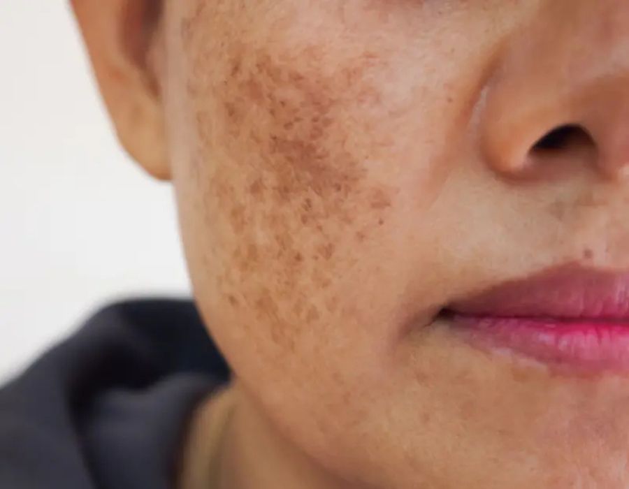 How to Treat Melasma From the Inside Naturally? how to cure melasma from the inside