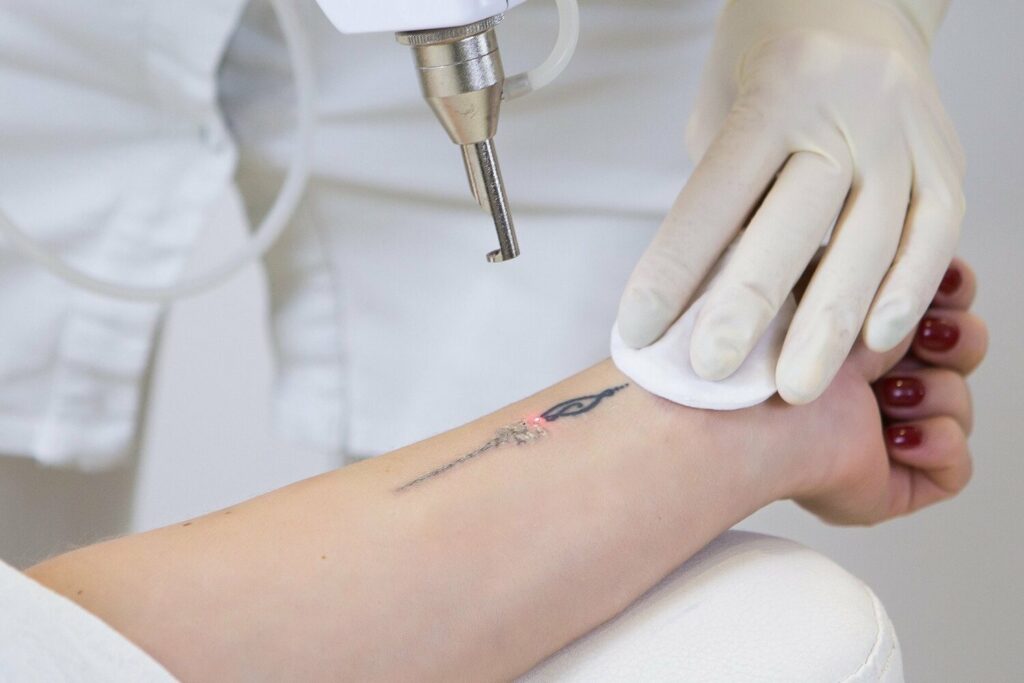 Can Permanent Tattoo Be Removed by Laser? Can Permanent Tattoo Be Removed by Laser?