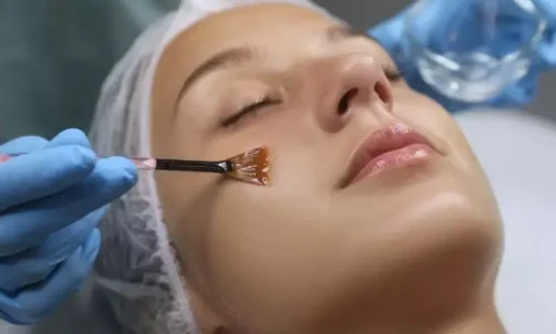 Chemical Peel