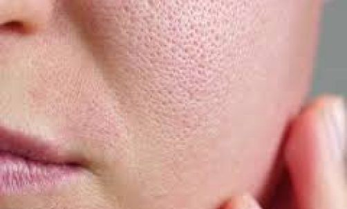 Open Enlarged Pores