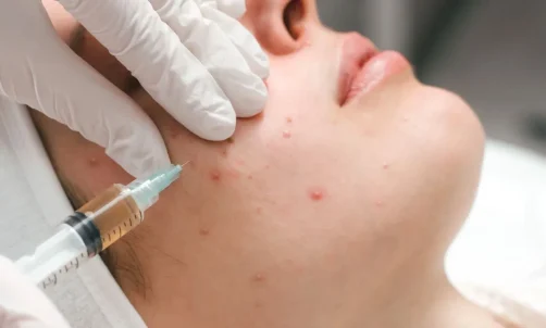 Intralesional Injection