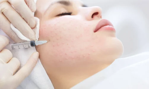 Skin Booster Injections